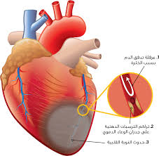 طبيب يمني يكشف عن ازدياد ظاهرة النوبة القلبية بين الكبار والصغار ويسرد تحذيرات مهمة للنجاة منها